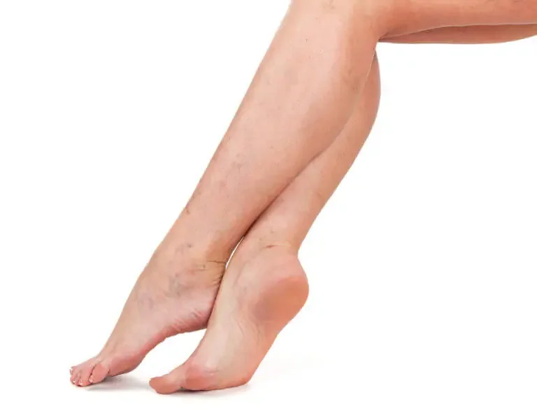 Guide to Varicose Vein in Legs: Understanding the Treatment Options
