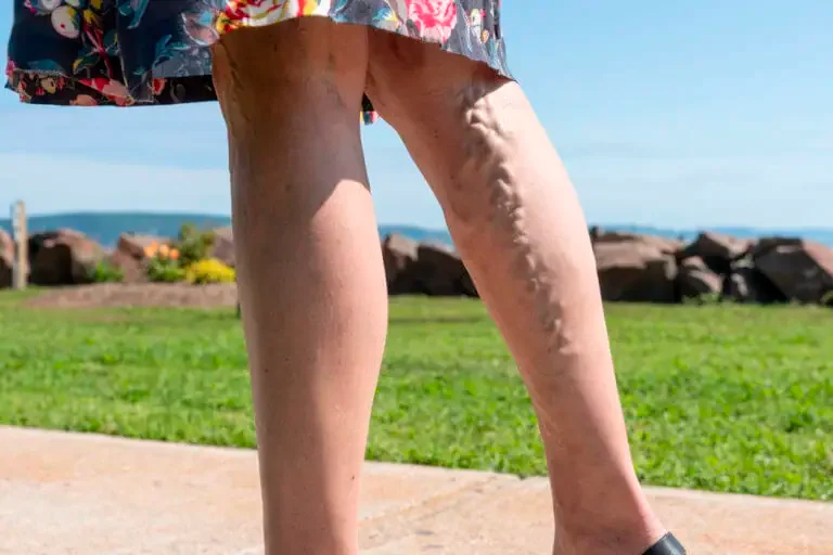 Leg Vein Treatments: Which One Is Right for You?