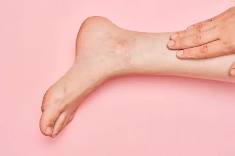 Tips for Painful Veins Treatment You Can Do at Home