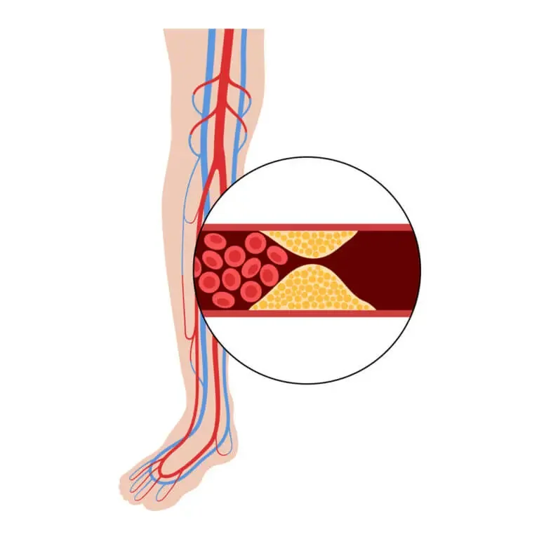What Causes Leg Vein Blockages?