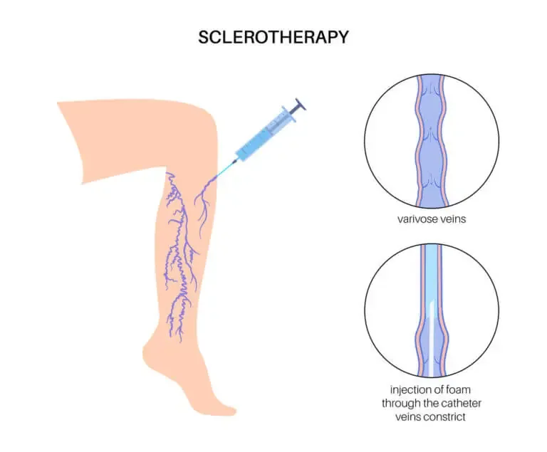 How Effective Is Sclerotherapy For Spider Veins?