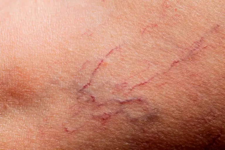 How to Get Rid of Spider Veins
