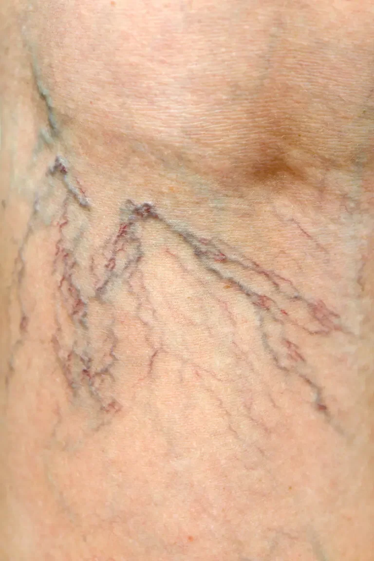 Preferred Diet For Venous Insufficiency