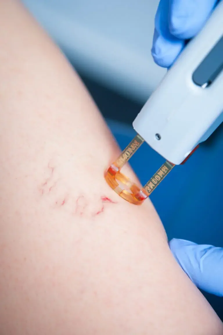 How a Spider Vein Removal Procedure Is Performed