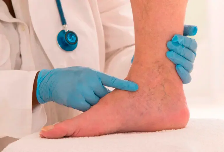 Varicose Veins Patient Guide