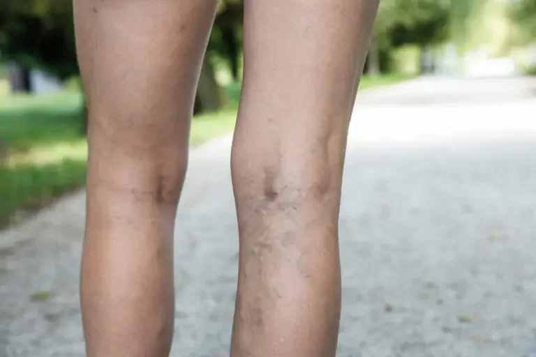 How to Identify Venous Diseases