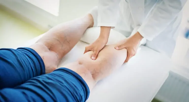 Are Varicose And Spider Veins Preventable?