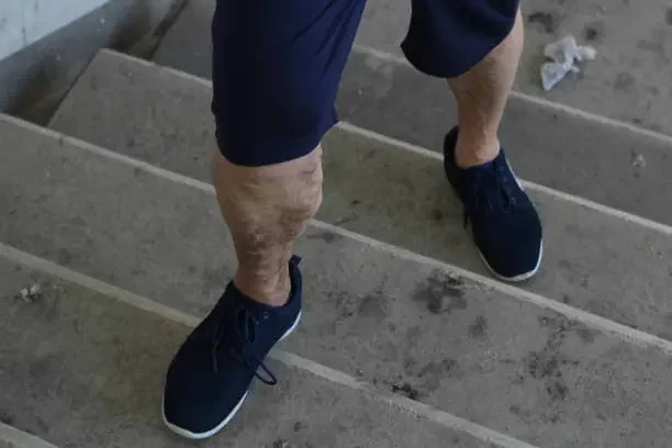 Recovery Tips After Varicose Veins in Legs Treatment