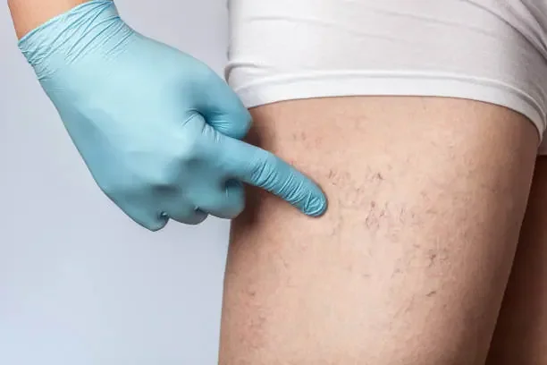 Sclerotherapy for Spider Veins: Expectations and Care Tips