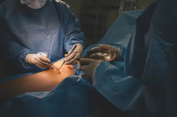 Recovery After Vein Surgery on Legs