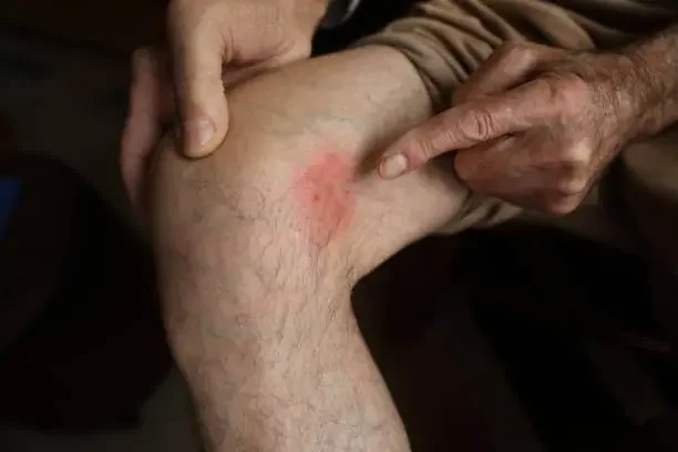 Varicose Veins in Legs: Tips to Prevent and Treat Them