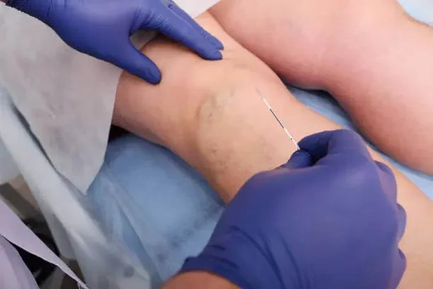 What Procedures Do Vein Surgeons Perform?
