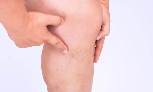 Deciding When to Get Vein Treatment