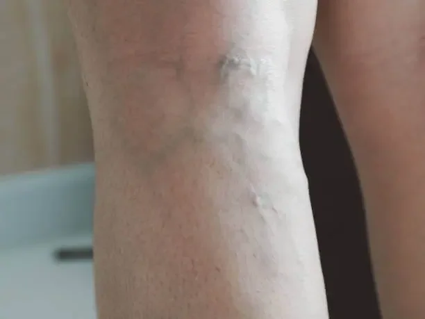 Five Facts About Varicose Veins