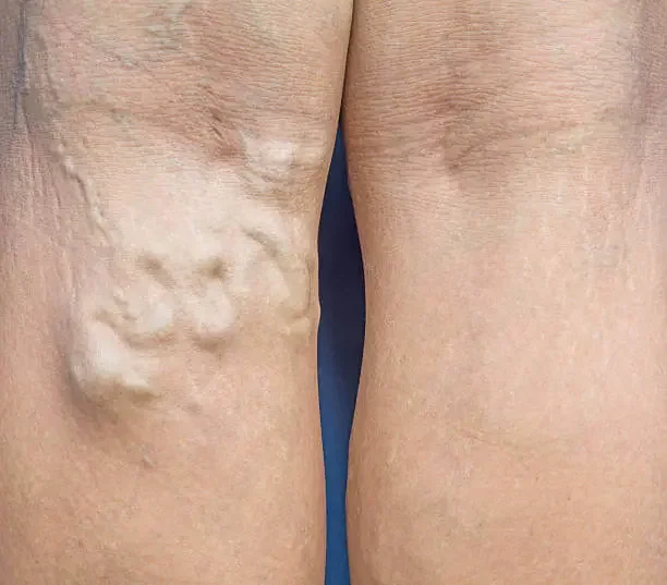 What It’s Like Living with Varicose Veins in Legs