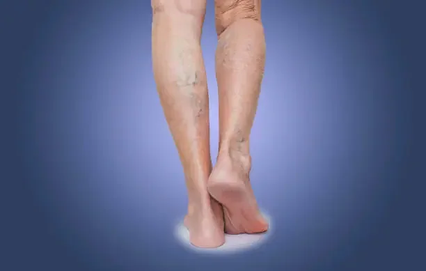 How to Prevent Varicose Veins from Getting Worse