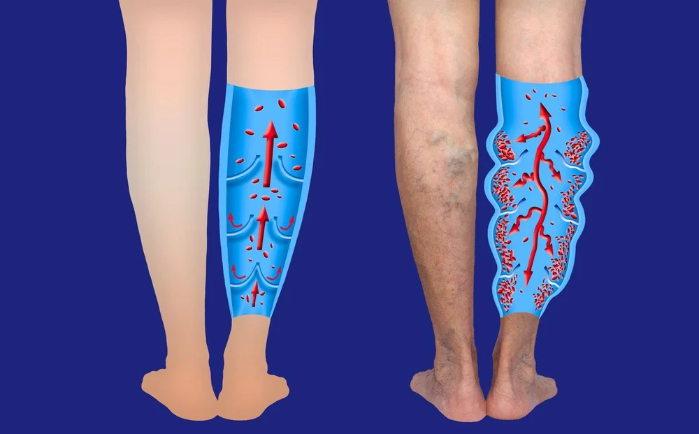 leg blood flow diseased veins