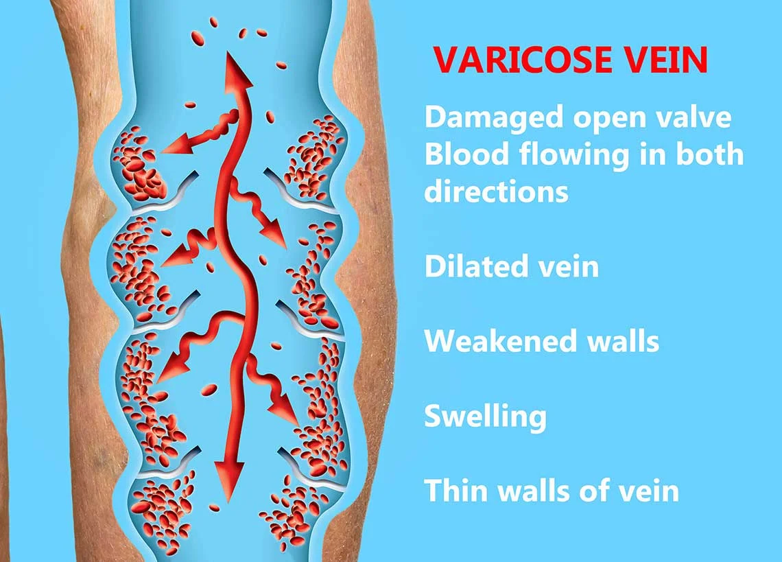 varicose vein causes infographic