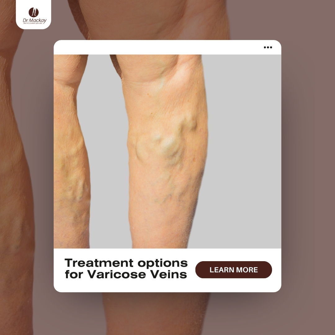 MAC_-_3_Varicose_vein_treatments_-_IG