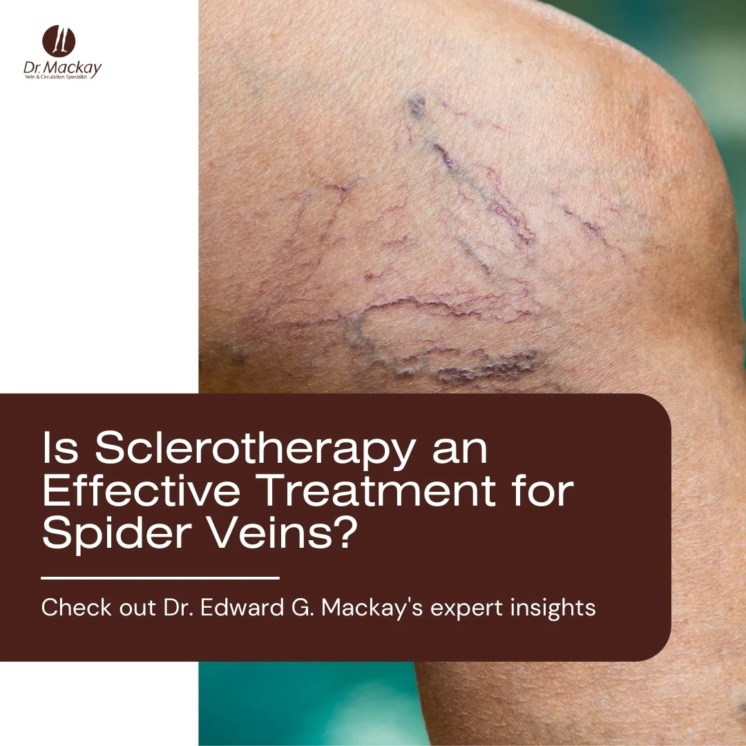 MAC_-_4_Spider_veins_removal_blog_-_IG