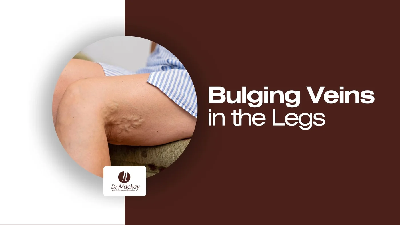 Bulging Veins in Legs
