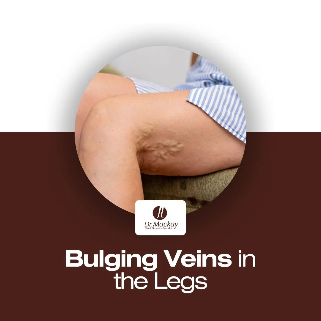 MAC - Bulging veins in legs - IG post Dr Mackay vein surgeon