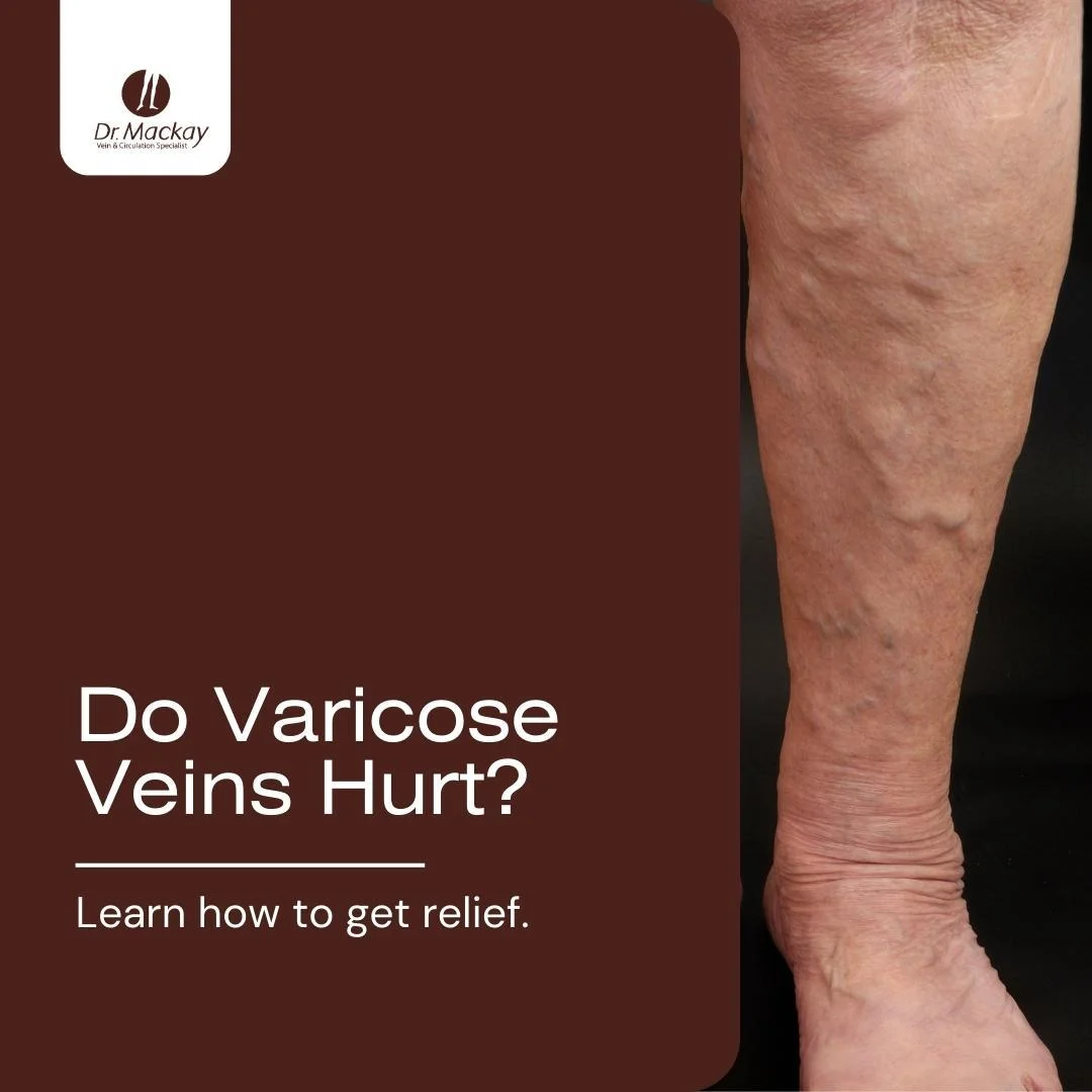 MAC-Do_varicose_veins_hurt_-_IG
