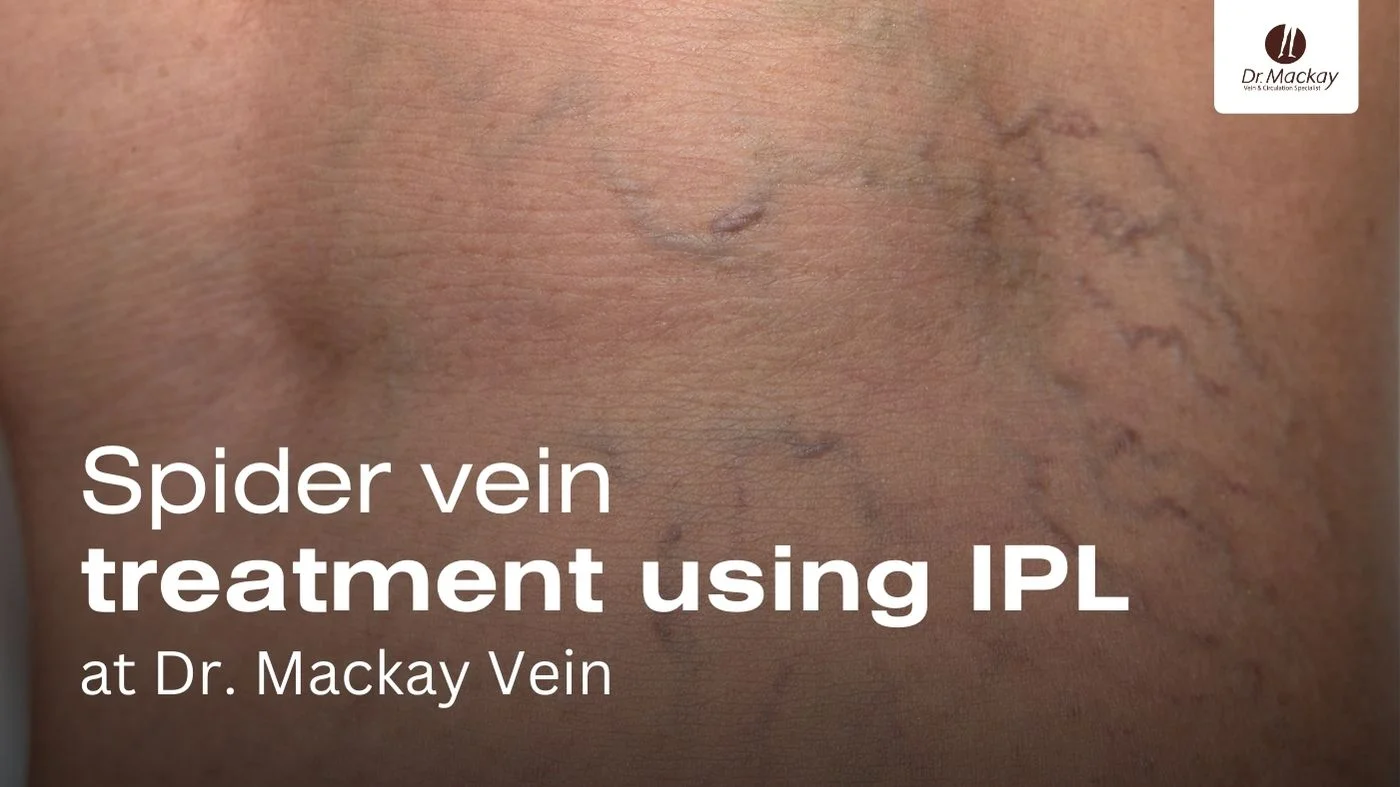 IPL Spider Vein Treatments