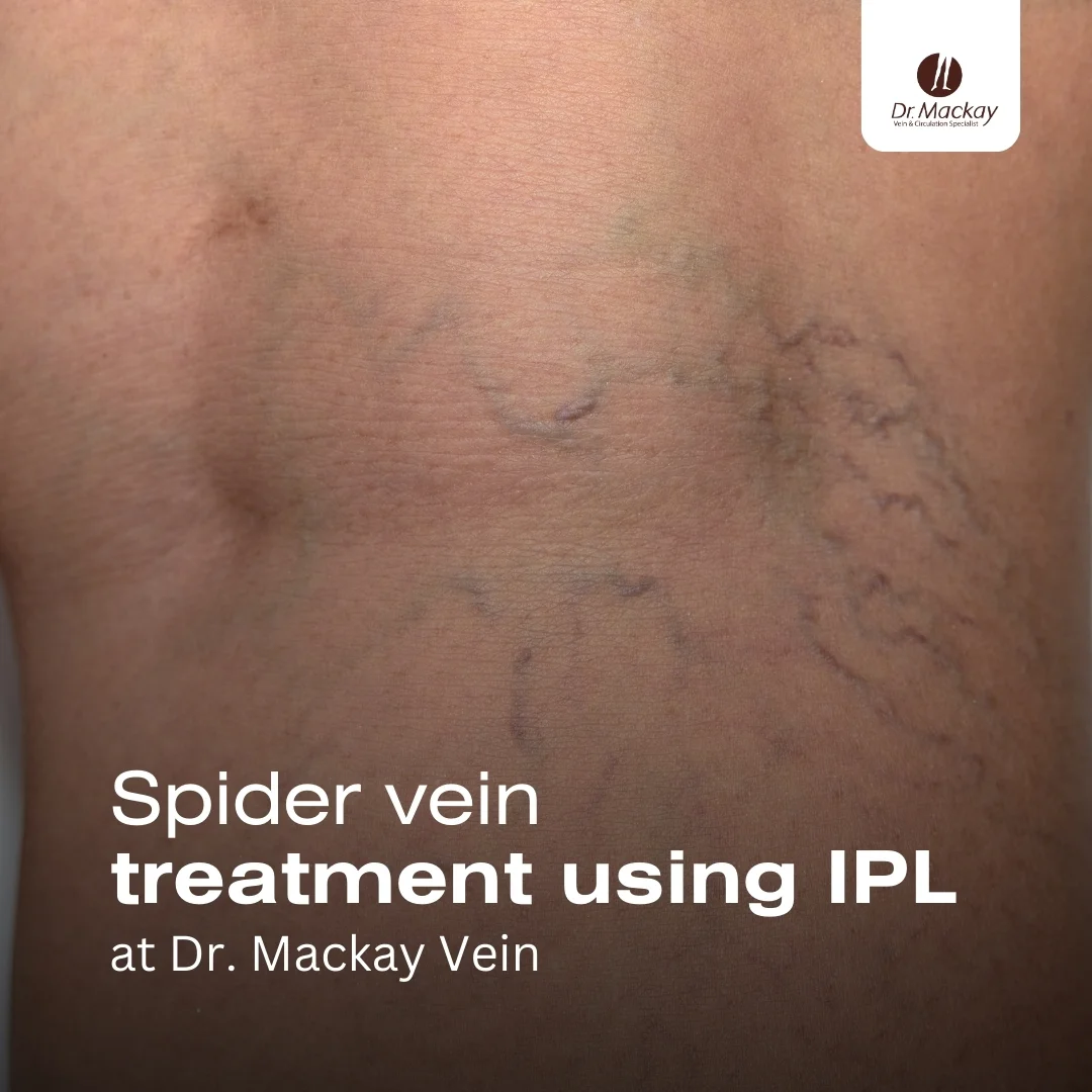 MAC_-_Spider_vein_treatment_using_IPL_-_IG_(1)