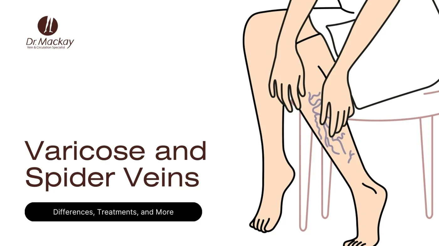 spider veins vs varicose veins comparison guide banner