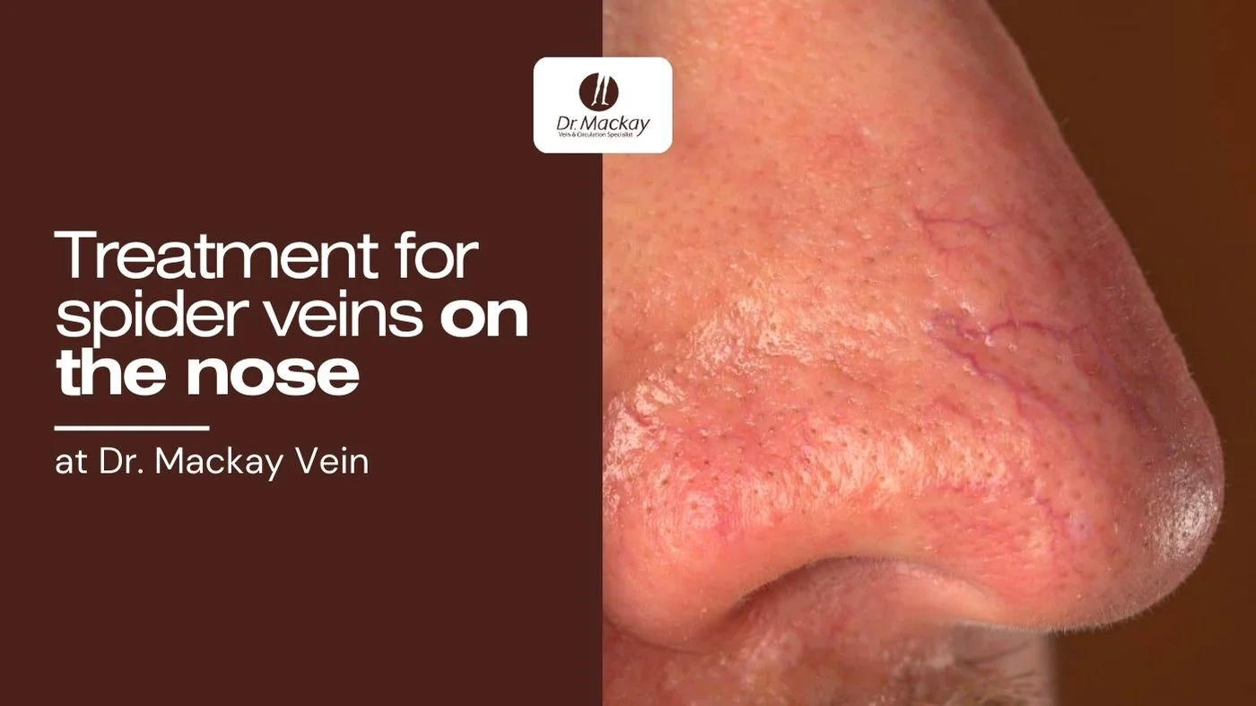 Spider Veins on the Nose Treatment Options