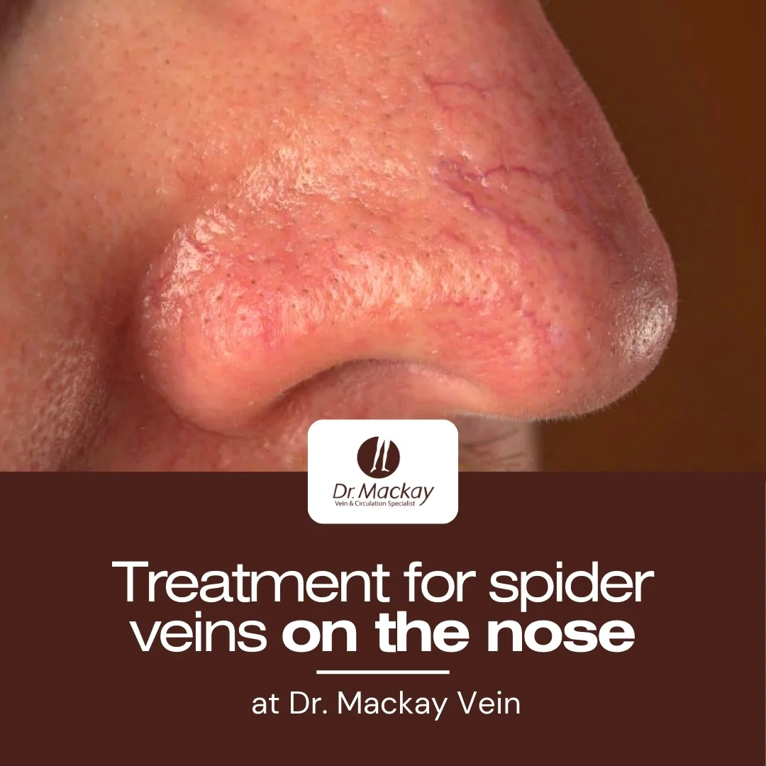 MAC_-_Treatment_for_spider_veins_on_the_nose_-_IG