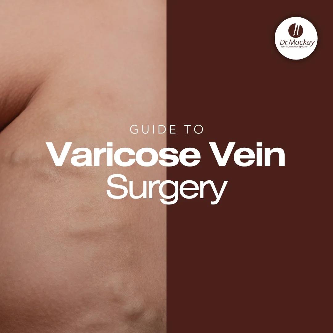 MAC_-_Varicose_Vein_Surgery_Guide