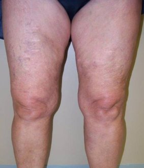 After treatment — Varicose veins · Case 1