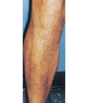 After treatment — Varicose veins · Case 2