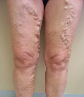 Before treatment — Varicose veins · Case 1