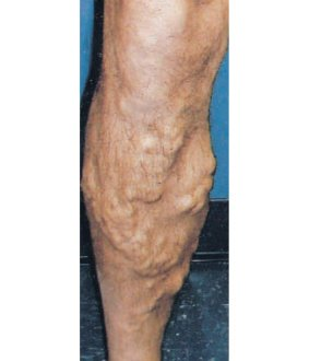 Before treatment — Varicose veins · Case 2