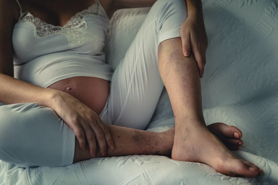 Pregnancy and Varicose Veins