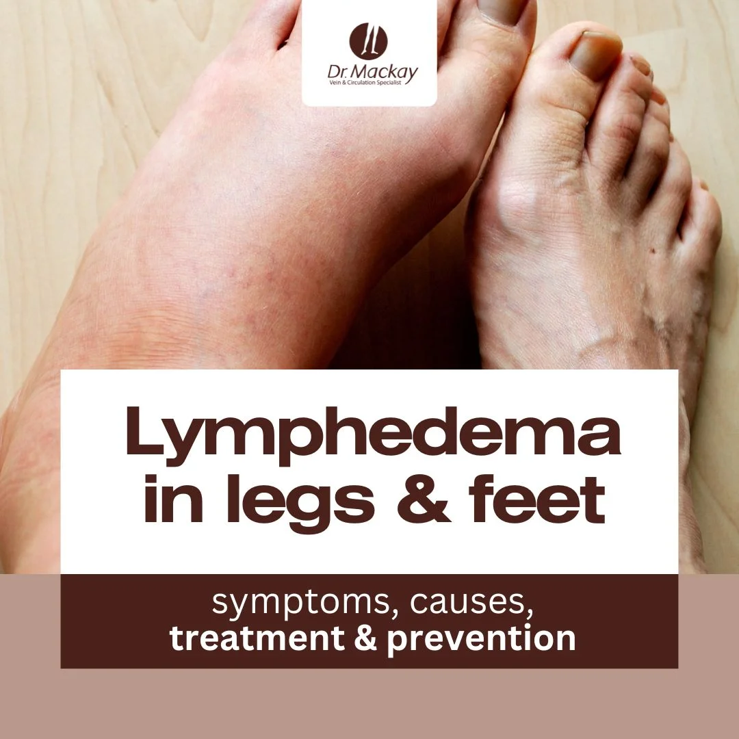 MAV - Lymphedema in legs & feet - IG