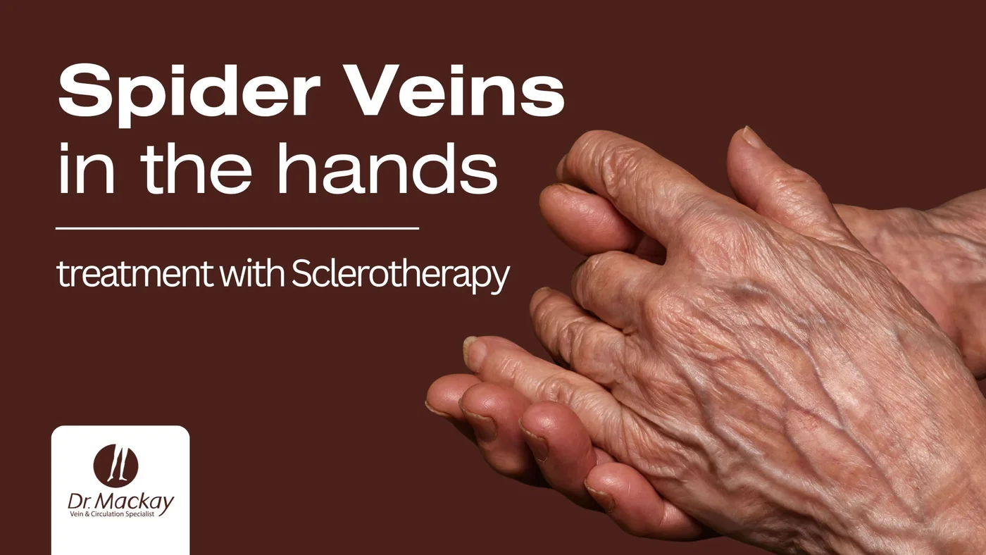 Hand Sclerotherapy for Spider Veins