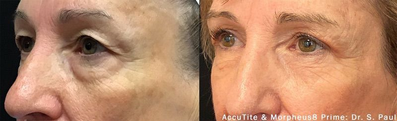 morpheus-8-before-after-135