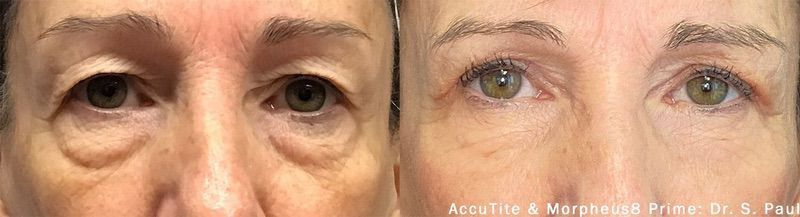 morpheus-8-before-after-136
