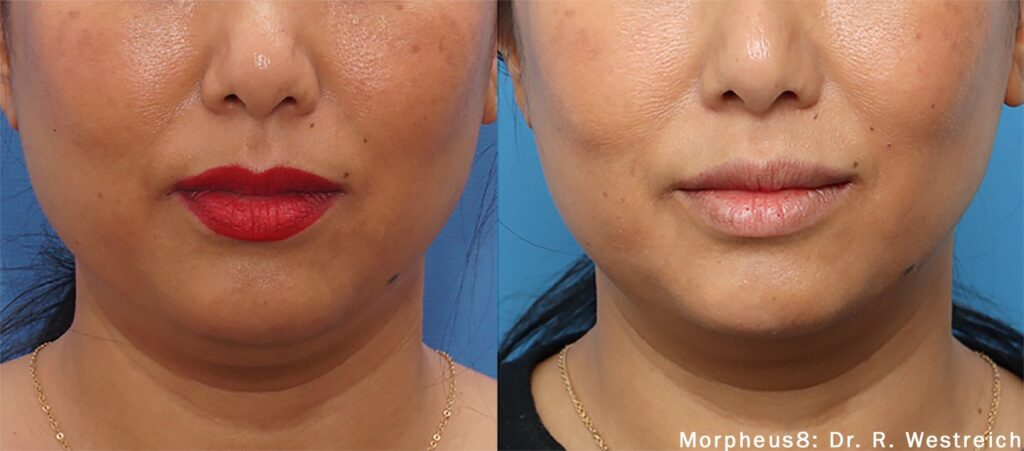 morpheus-8-before-after-137