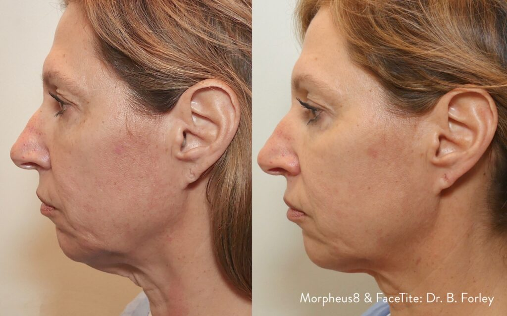 morpheus8-facetite-before-after-dr-b-forley-preview-1 Large