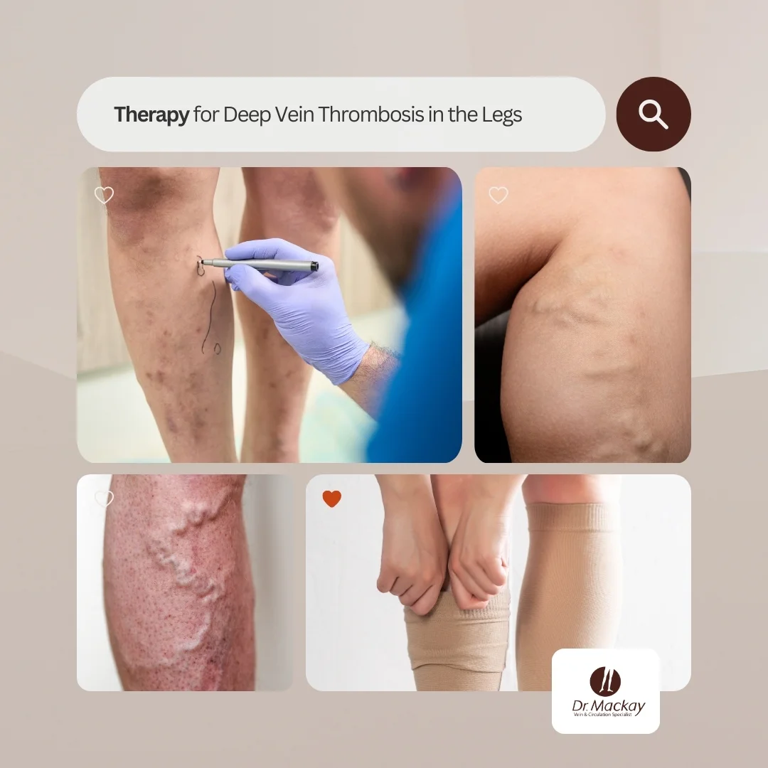 MVC - Treatment for DVT in the legs - IG