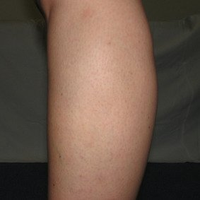 reticular-spider-vein-treatment-after-drmackay-2