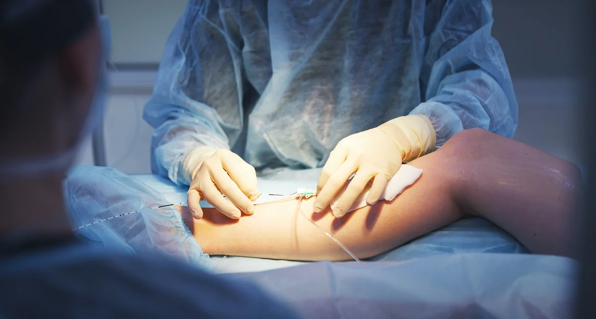 Varicose Vein Surgery Revisions