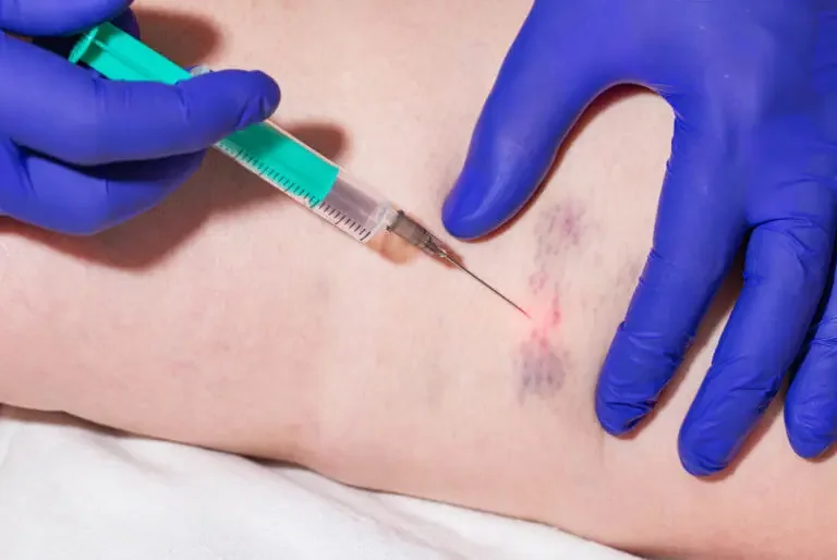 Sclerotherapy: A Procedure for Treating Varicose and Spider Veins