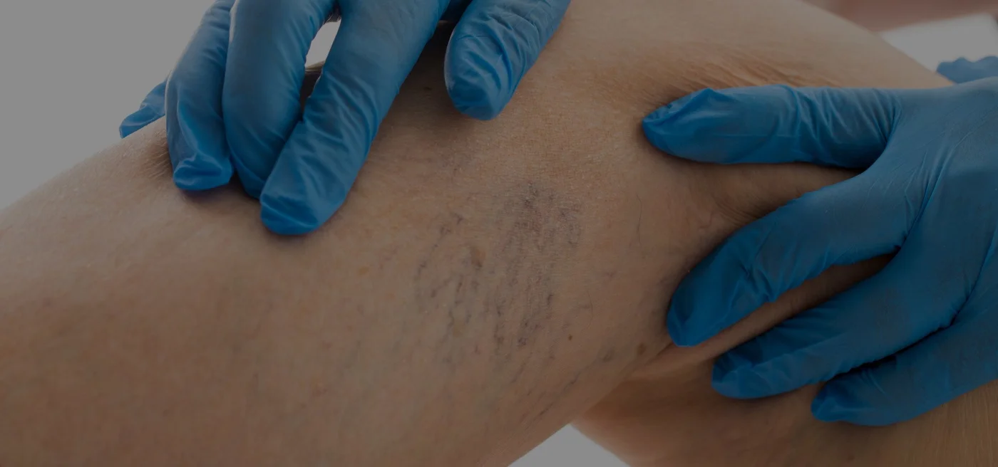 spider-vein-exam