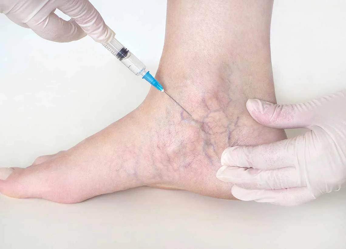 spider vein sclerotherapy treatment